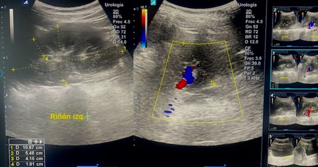 Ecografía Renal-vesical